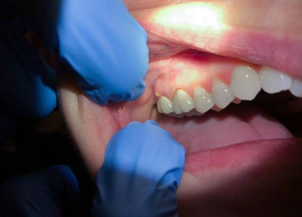 Best Knocked-Out Tooth Emergency  in Seymour, TX